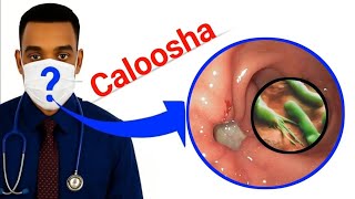 Gaas Calooleedka Sida Ugu Fudud Ee Loo Dabar Jaro Ama Loo Daaweeyo