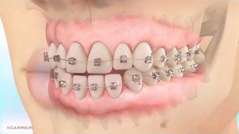 Carriere Class III distalization