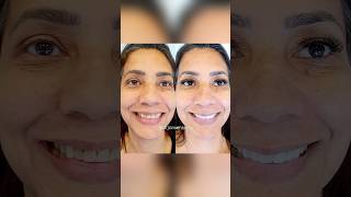 Lente De Contato Pequeno Detalhe, Grande Diferença