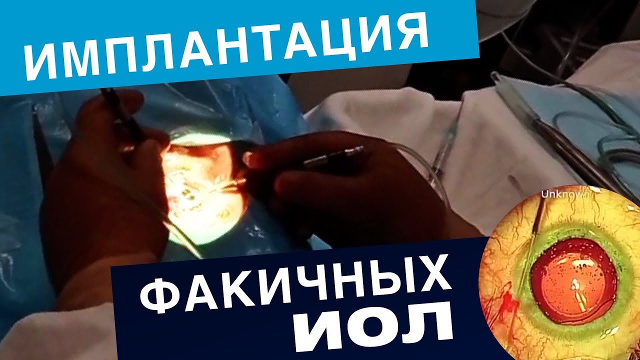 Имплантация факичных линз. Офтальмологическая клиника "Эксимер"