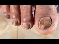 Dirty nail cleaning by [ Doctor Ming ]