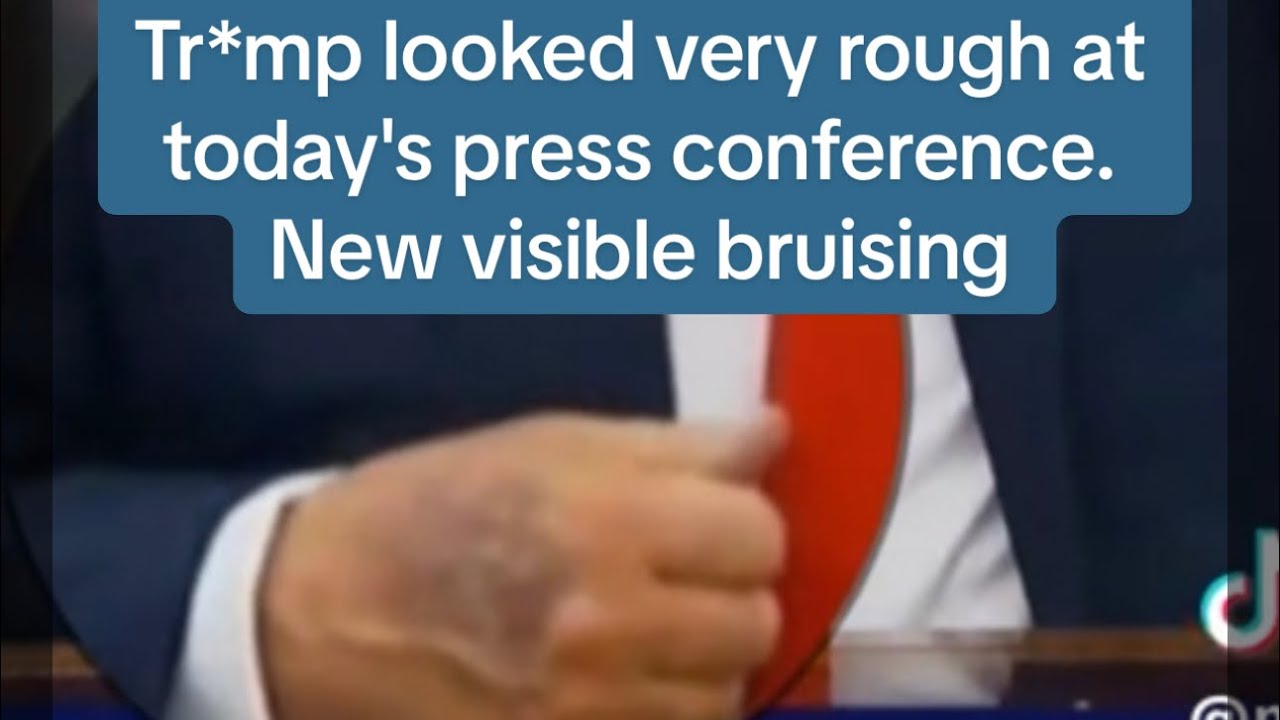 Tr*mp looked very rough at his press conference today 