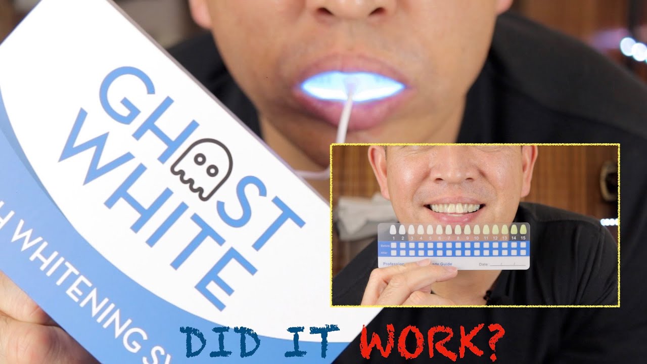 Teeth Whitening at Home