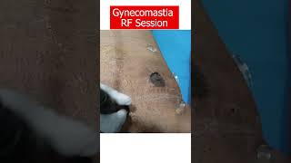 Gynecomastia Surgery Cost | Manboobs Cure | Dressing removal