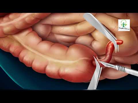 3D Animated Appendix Surgery Explained BySurgery Medi Care 3D