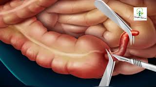 3D Animated Appendix Surgery Explained by//Surgery Medi Care 3D screenshot 3