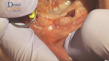 How to select a Finder Abutment video