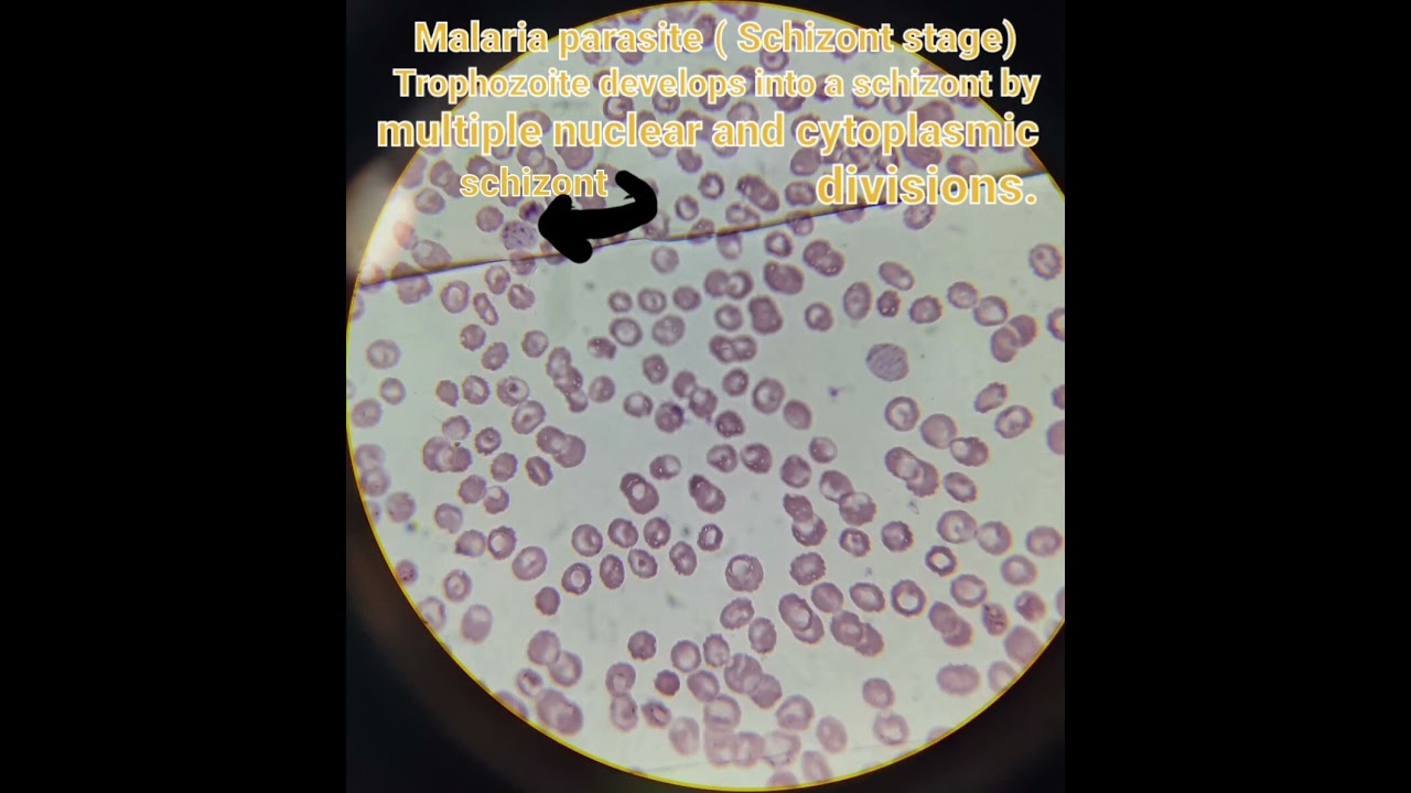 Malaria