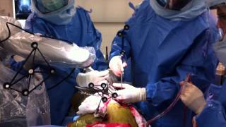 Total Hip Replacement Using MAKO Robotic Assistance Resimi