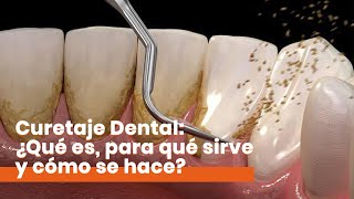 Curetaje Dental: ¿Qué es y cómo se hace?