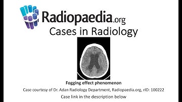 Fogging effect phenomenon (Radiopaedia.org) Cases in Radiology