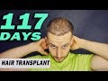 FUE Hair Transplant Day 117 (post op) Istanbul, Turkey GROWTH STAGE