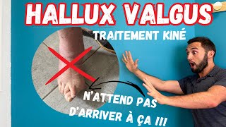 Hallux Valgus? Soignes ca !!! Aide du kiné !!! Comment soigner l'#hallux valgus ?
