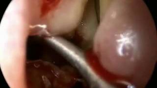 Uncinectomy Procedure with Microdebrider
