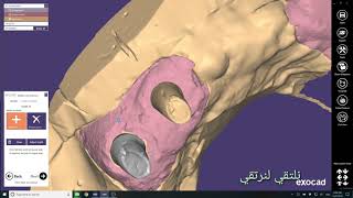 Exocad (9)wax up screw retain case أ.حسان نور الدين