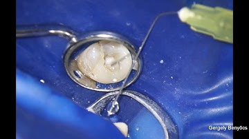 Shaping without glide path.