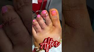 Curved Toes and Unsightly Toe Corns #podiatrist #footdoctor