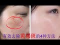 黃褐斑是怎麼形成的?有效去除黃褐斑的4種方法!