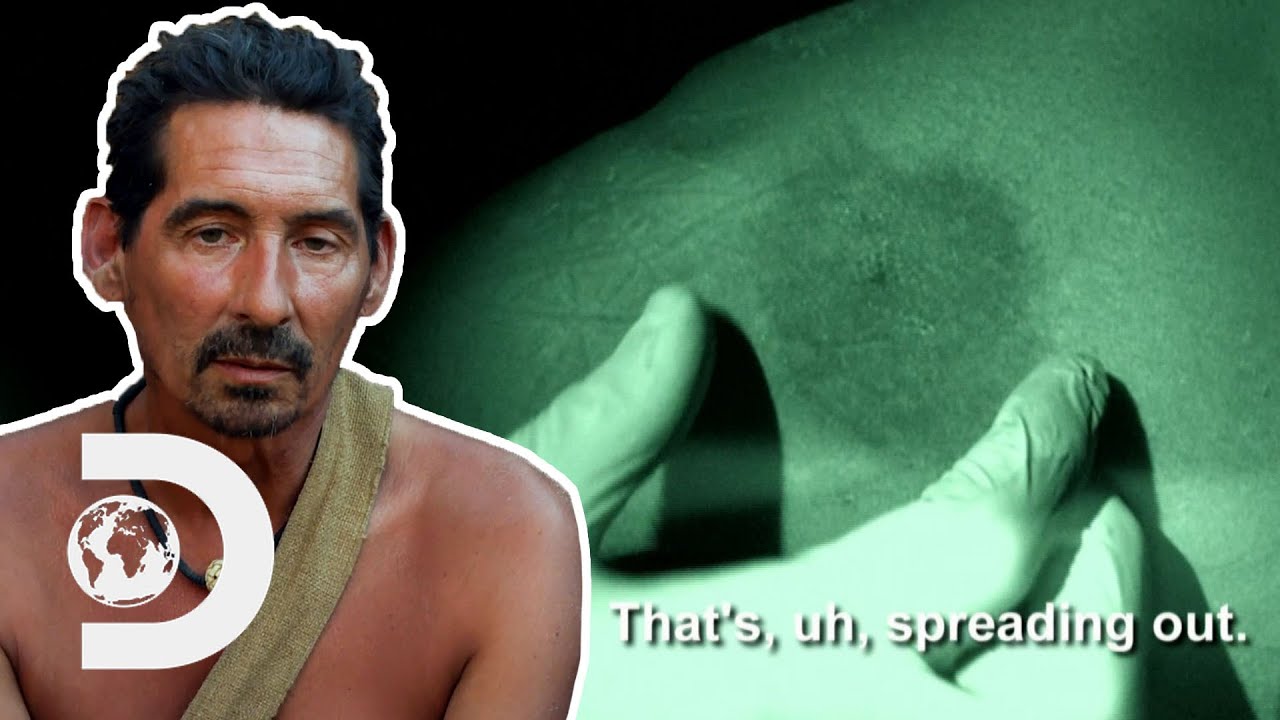 Download Participant Is Bitten By A Venomous Insect And May Have To Leave The Competition | Naked And Afraid