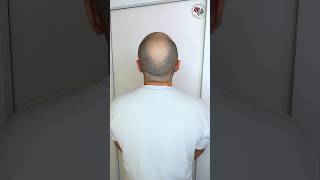 Маскировка облысения надолго, нет залысинам! Трихопигментация Smp scalp micropigmentation