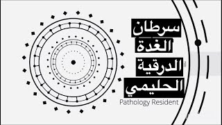 سرطان الغدة الدرقية الحليمي Papillary Thyroid Carcinoma