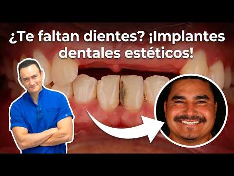 ¿Te faltan dientes? Implantes dentales estéticos, ¡Caso real!