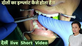 दाँतों का इम्प्लांट कैसे होता है | dental implant prosthetic procedure