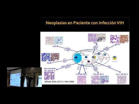 Neoplastias asociadas a VIH