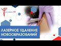 Удаление папиллом: как происходит удаление папиллом?