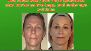 Facial Workout Exercises As An Eye Bag, Dark Rings, Under Eye Wrinkle Home Remedy