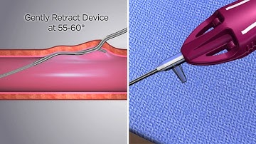 AXERA 2 -- Femoral Artery Access Device