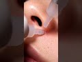 Hard Blackheads Gone! Pore Vacuum Extreme Close-Up #macroasmr #blackheadcaique #satisfying