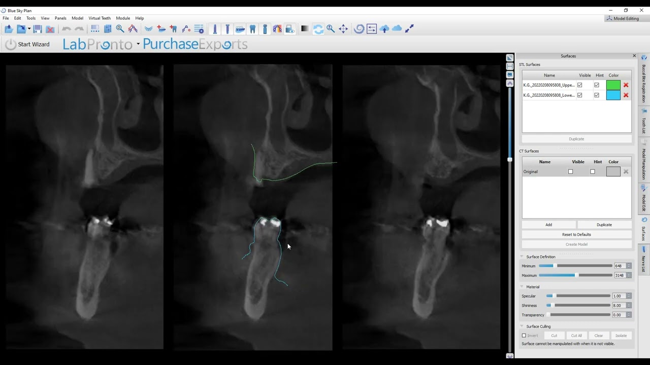 Will This CBCT Scan Work for a Guided Surgery???