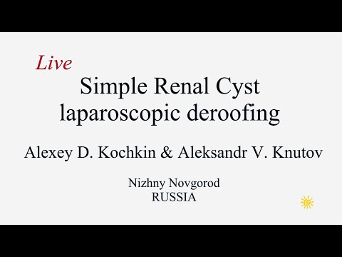 Renal cyst deroofing or decortication/Иссечение или декортикация кисты почки/Живая хирургия/Кочкин