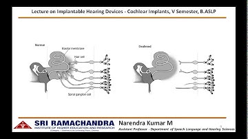 Cochlear Implant   Basic function of speech processor