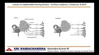 Cochlear Implant   Basic function of speech processor