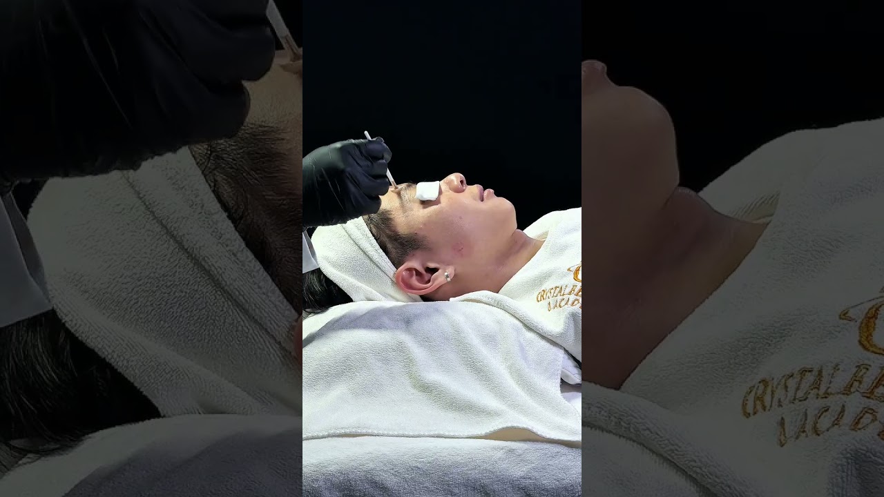 Quy trình Peel không bong - Mandelic Clear Peel (Công thức cho da căng bóng, da mụn)