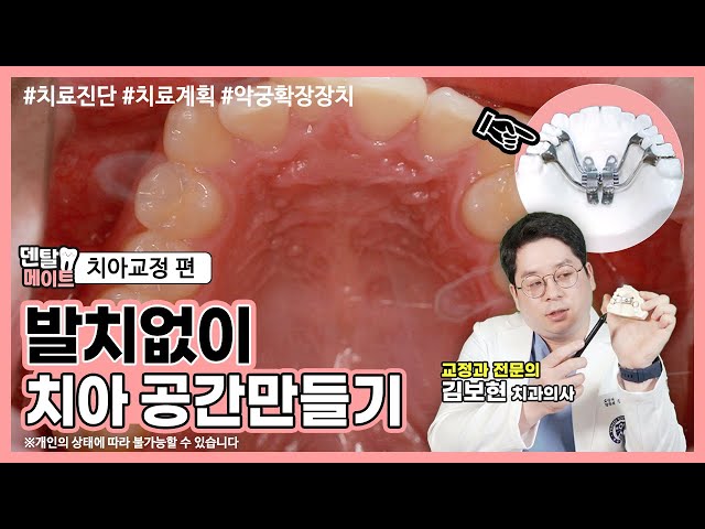치아교정 발치없이 치아 공간 만들 수 있나요? (악궁확장장치)  [비발치교정케이스 치료진단, 치료과정, 치료계획]  | 덴탈메이트