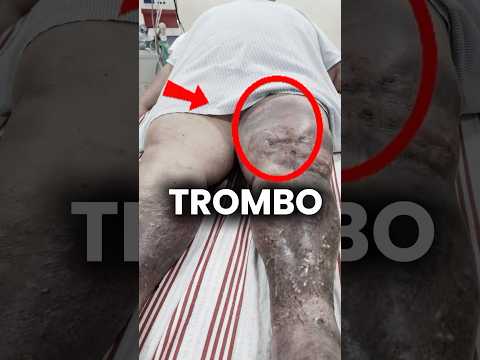 ¡Alerta! Este el verdadero peligro de que se te forme un trombo en la pierna. #medicina #shorts