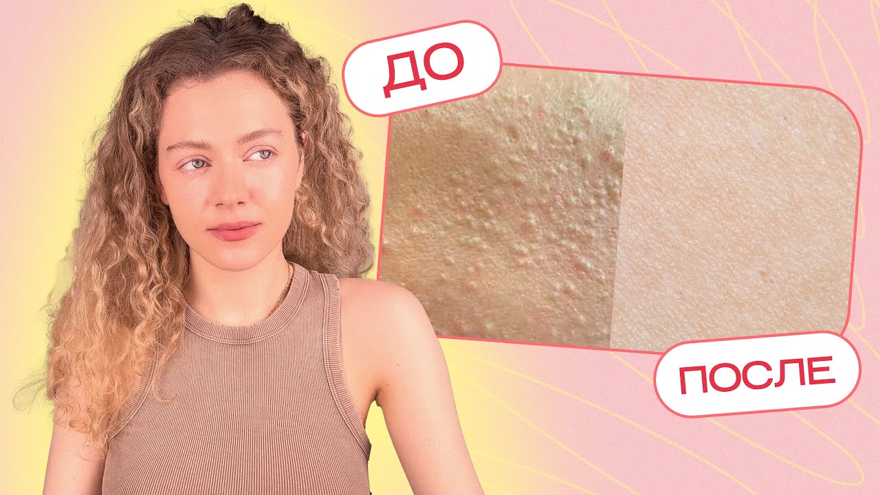 ТЕКСТУРА и неровный РЕЛЬЕФ КОЖИ - как избавиться?