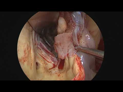 Transaortic Septal Myectomy