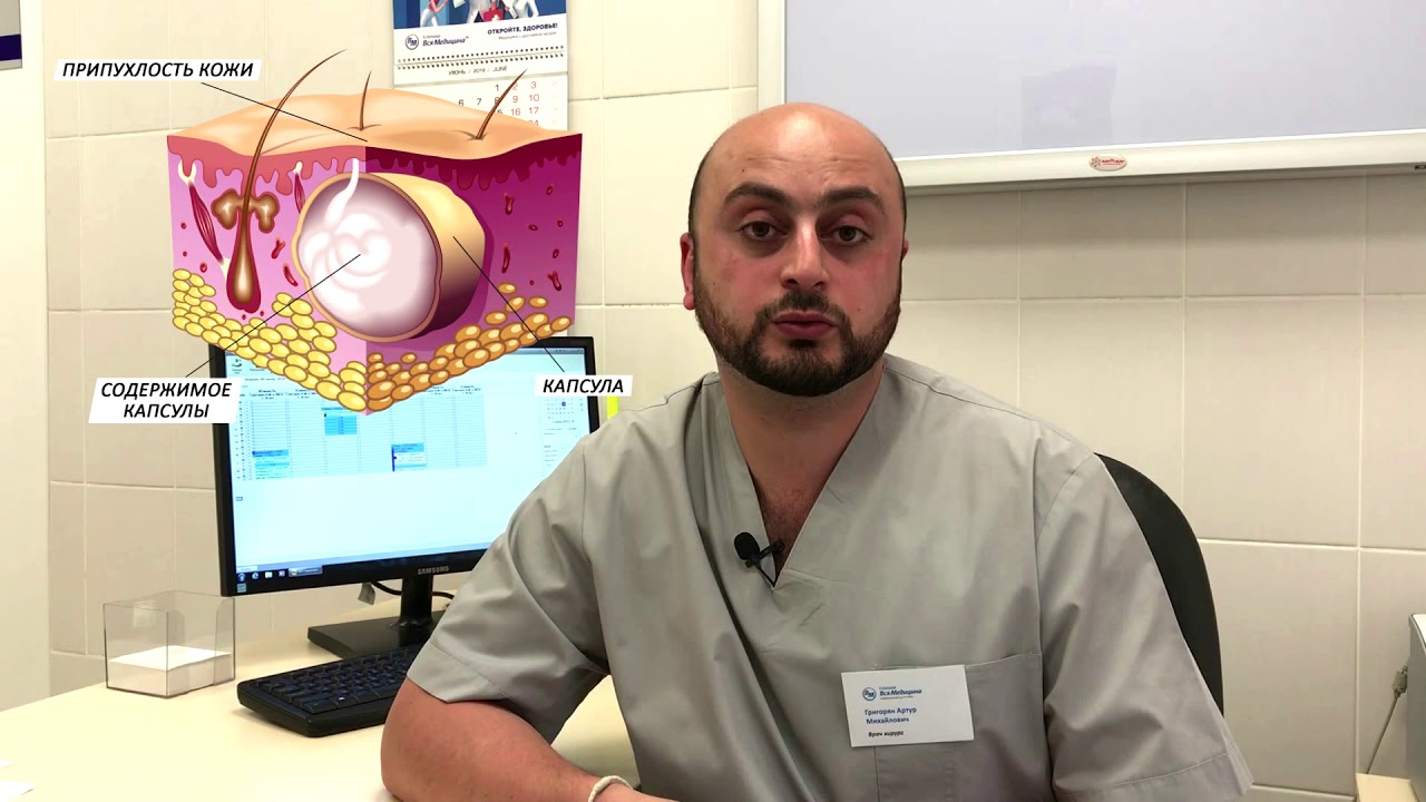 Лечение атеромы кожи в Клинике Вся Медицина - YouTube