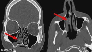 Chronic Nasal Congestion Caused by Drugs Hidden in Nose?