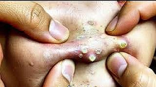 [ASMR] Blackheads Removal and Whitehead Removal for Deep Pore | Remove Blackhead