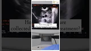 How many eggs are collected during IVF treatment? Dr Rhythm Gupta -IVF specialist at Excel IVF