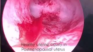 Hysteroscopy In Menopause Essment