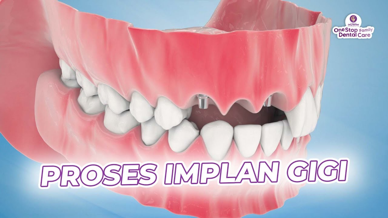 ANIMASI PROSES IMPLAN GIGI