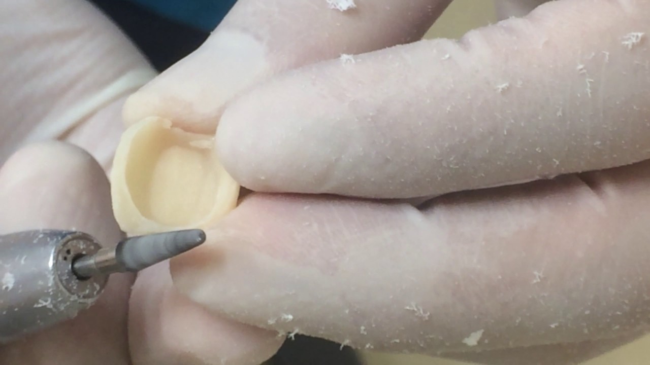 右下6番の仮歯作成(9/21)マージン出しとコンタクト付近の切削の注意点