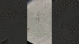 Calcium Oxalate With Candida Spp in urine analysis #urine #candidate #analysis