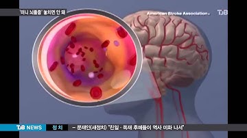 [TJB뉴스]닥터리포트-미니 뇌졸중